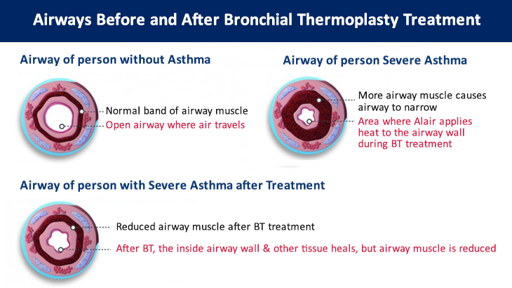 Bronchial thermoplasty